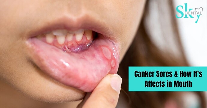 Canker-Sores-How-Its-Affects-in-Mouth
