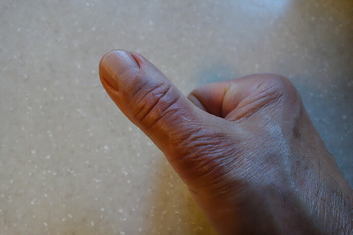 thumb caught in rat trap